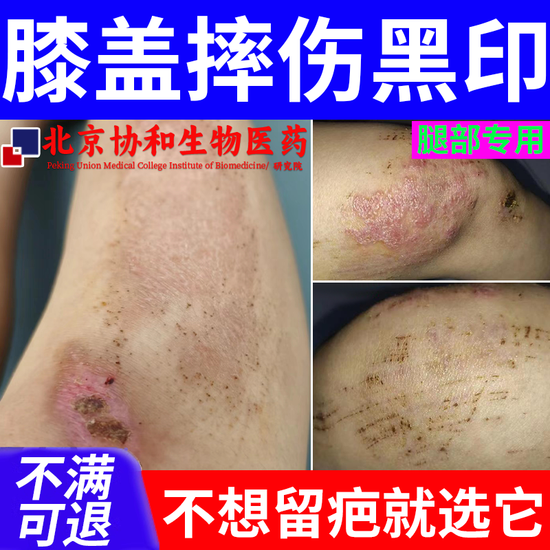 膝盖腿上去疤印去黑色素沉淀