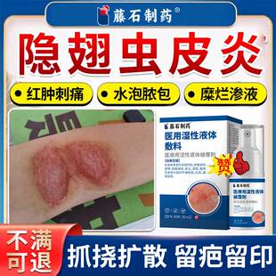 隐翅虫咬性皮炎叮咬伤止痒消肿蚊毒虫皮肤过敏发红灼热刺痛药膏SA