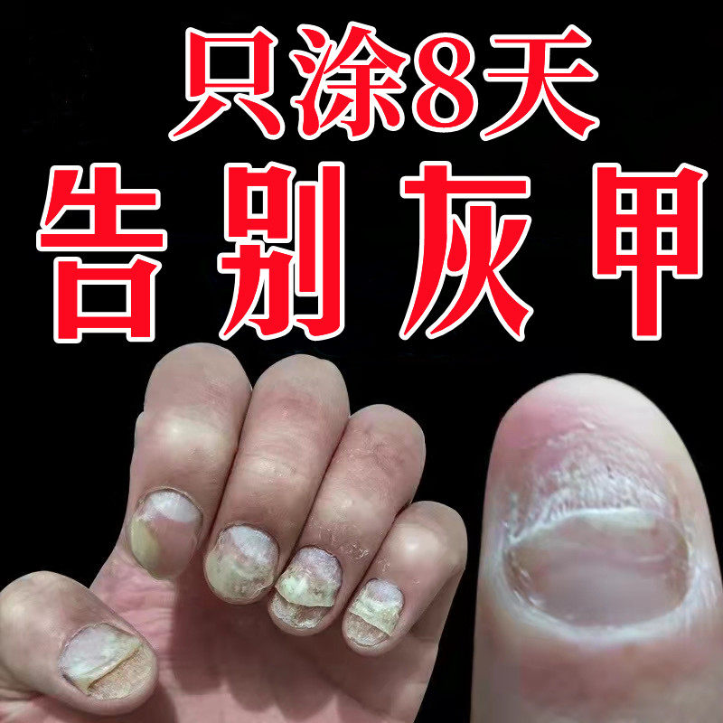 进鸿脚趾灰甲净修复液正品灰趾甲保健理疗