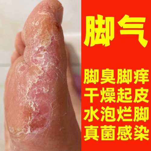 18年专攻脚气脚痒脱皮开裂