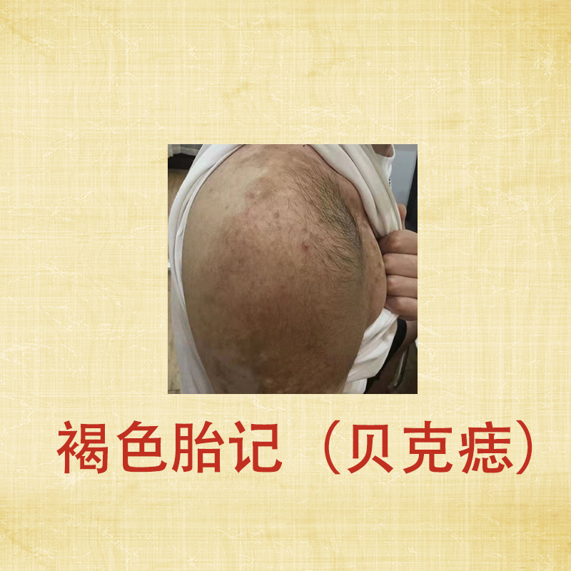 淡化褐色胎记祛除贝克痣胎记色素性毛表皮痣膏