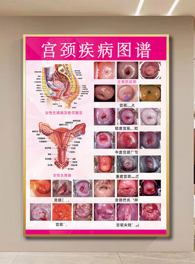 宫颈疾病示意图解剖图谱女性生殖系统挂画私密保养海报妇科广告图
