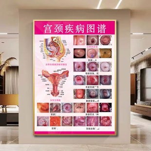 宫颈疾病示意图解剖图谱女性生殖系统挂画私密保养海报妇科广告图