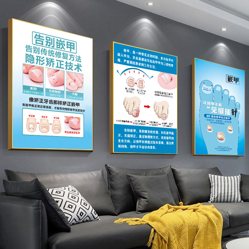 嵌甲挂画脚病图片灰指甲广告图修脚海报甲沟炎宣传画足疗店装饰画