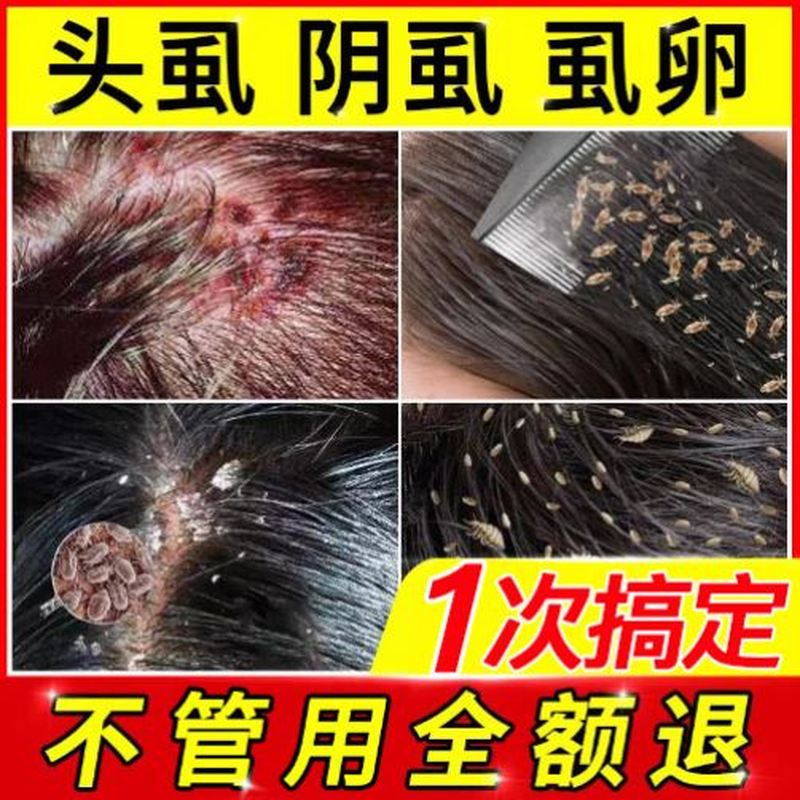虱立净虱子药小女孩头发治儿童头上长头虱子去除虱卵阴虱体虱药