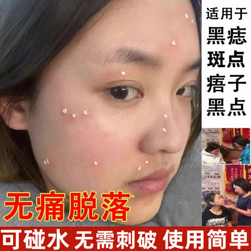 点斑水痣膏正品脸部药取痣去黑痣点雀子美容院专用神器去除志仪