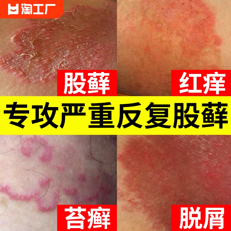 【专攻大腿内侧股藓】不返复