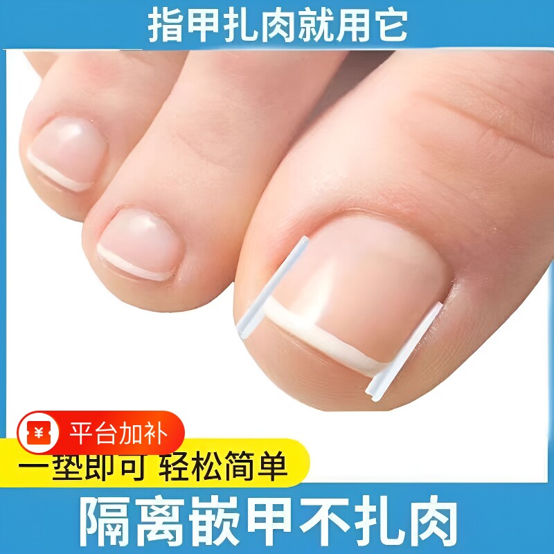 甲沟垫嵌甲指甲矫正器填充垫片正甲贴脚趾甲长肉里专用修甲刀棉花