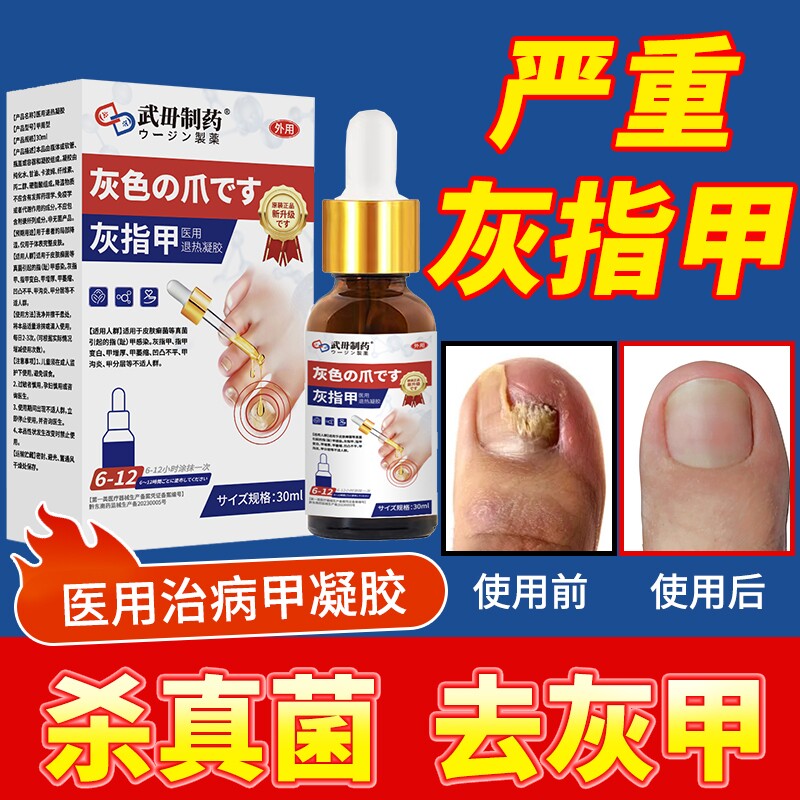 阿啊灰指甲莫罗芬搽剂正品旗舰店擦剂趾甲沟炎抑菌液药水甲床修复