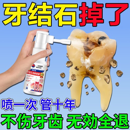 牙结石去除溶解除牙石非漱口水洗牙齿污垢牙黄牙垢牙渍牙龈口腔