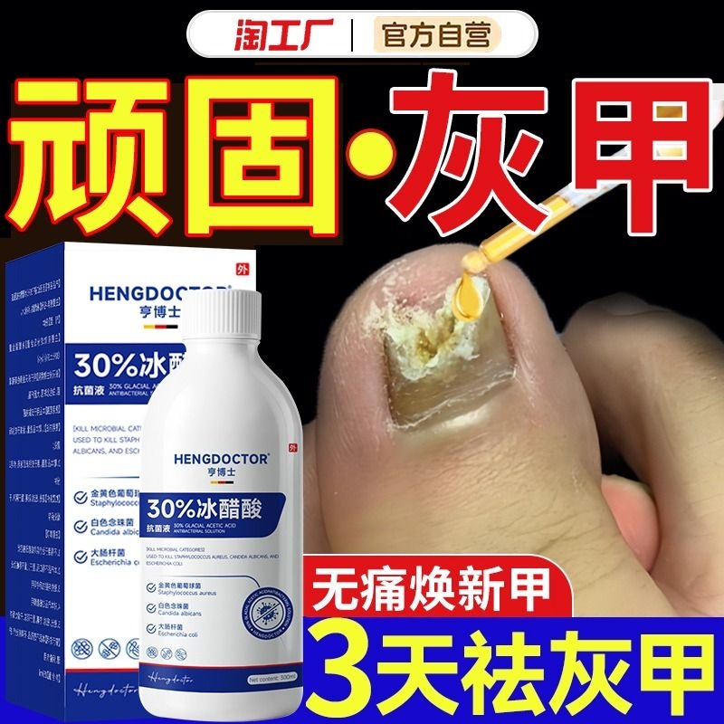 冰醋酸涂剂泡脚杀菌灰指甲