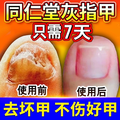 灰指甲专用阿莫同仁堂旗舰店修复脱甲膏罗芬真菌感染抑菌液搽剂