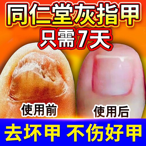 灰指甲专用阿莫同仁堂旗舰店修复脱甲膏罗芬真菌感染抑菌液搽剂