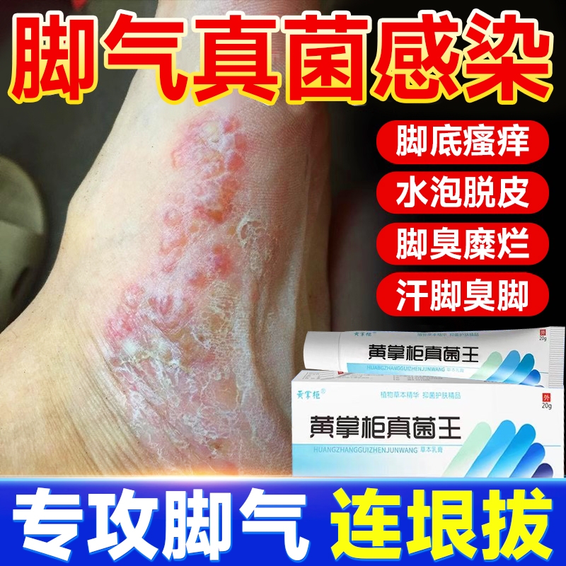 黄氏真菌王官网正品脚臭止痒脱皮脚痒水泡烂大腿内侧抑菌杀菌膏