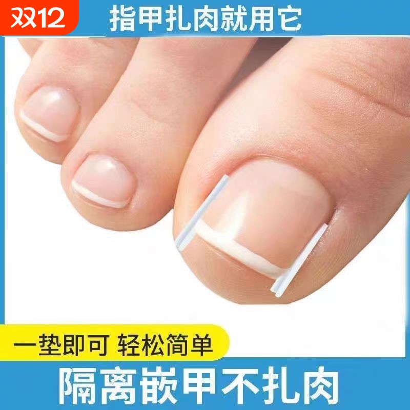 嵌甲矫正垫片|超6000次加购