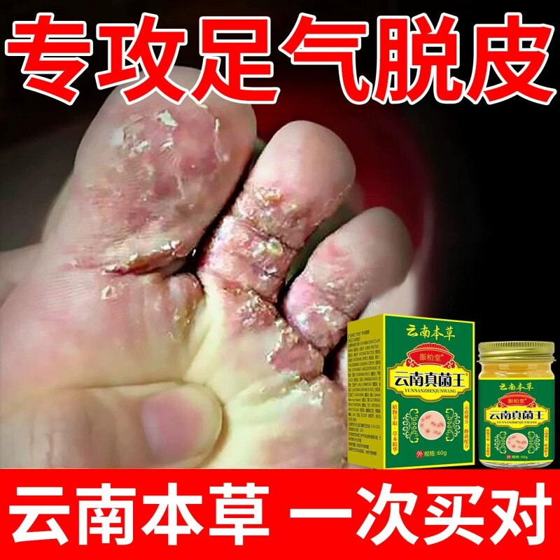 云南真菌王气脚脱皮脚痒脚臭脚缝痒烂脚膏防止水泡脚脱皮脚趾臭膏