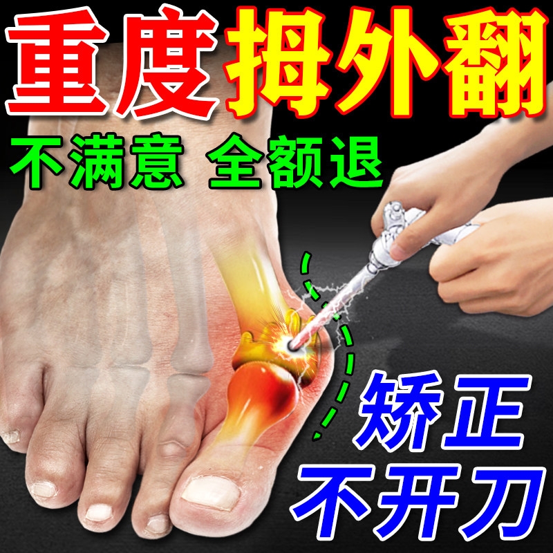 拇指外翻药膏贴拇囊炎疼痛大脚骨变形脚趾畸形肿胀矫正神器女克星