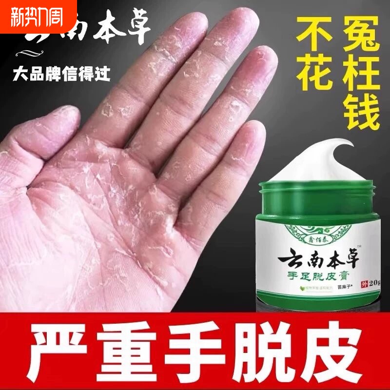 手足脱皮膏手指上真菌蜕皮干燥起皮童手掌蜕皮手心手脚掉皮褪专用