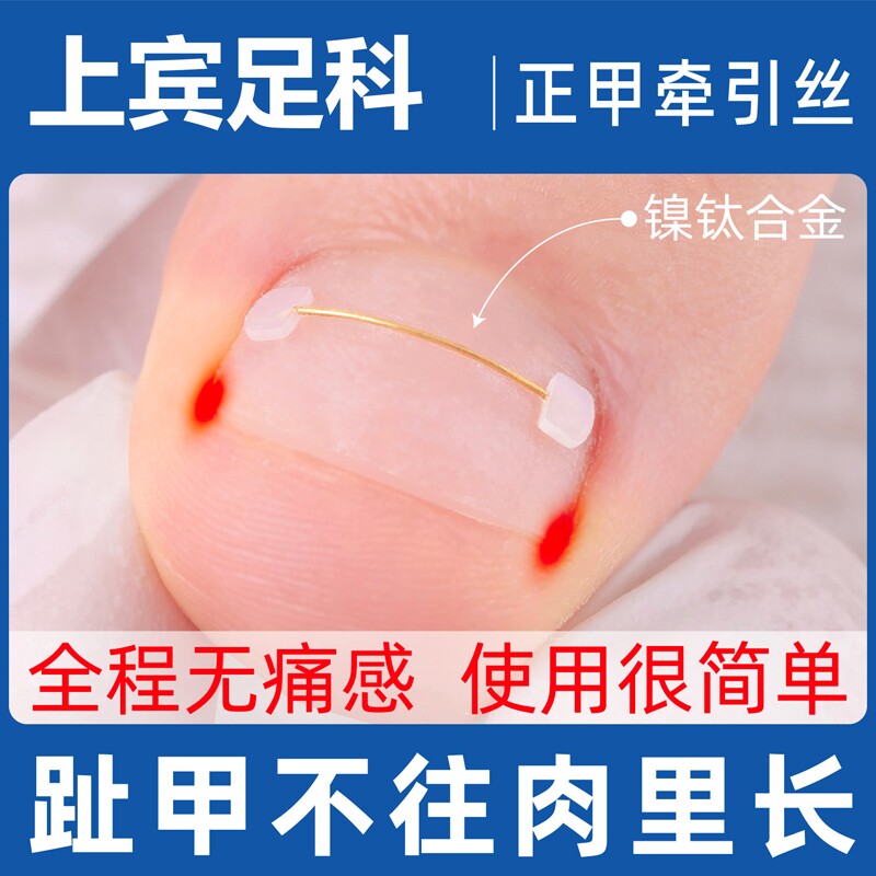 正甲丝甲沟矫正器镍钛合金回弹钢丝嵌甲正甲贴片脚趾甲扎肉神器炎