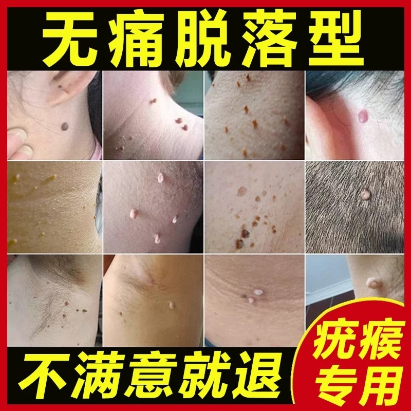 脖子上长小肉粒疣瘊疙瘩丝状疣腋下脸上猴子尤一抹无忧去神器除