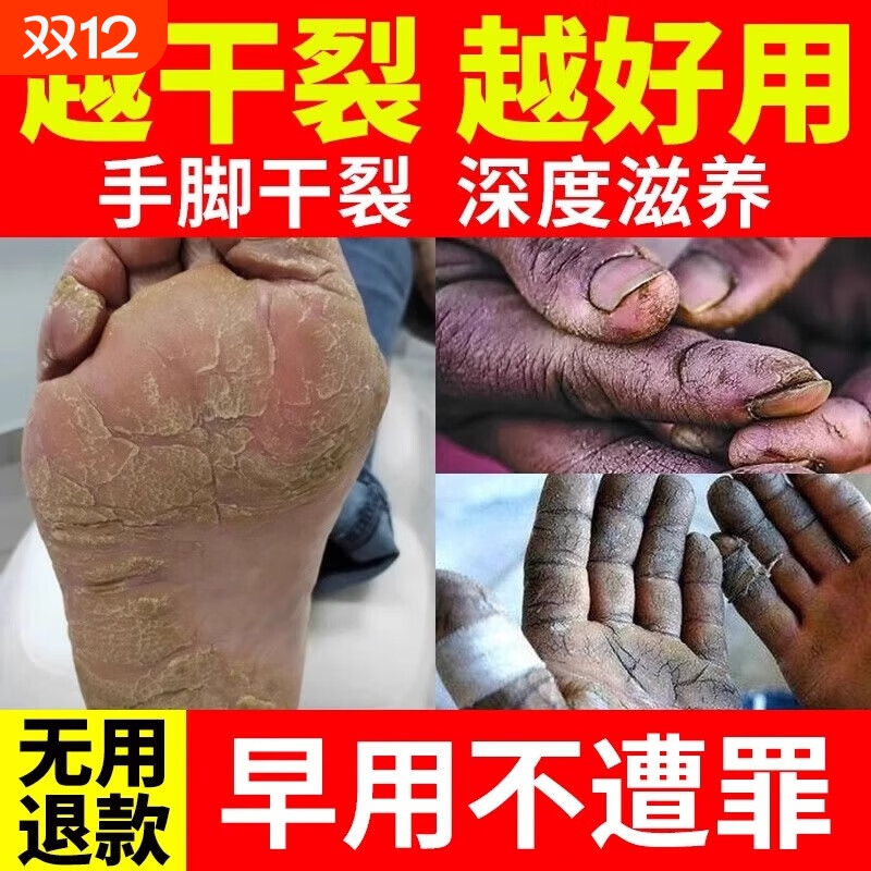 手裂口干裂修复霜冻疮膏皲裂膏