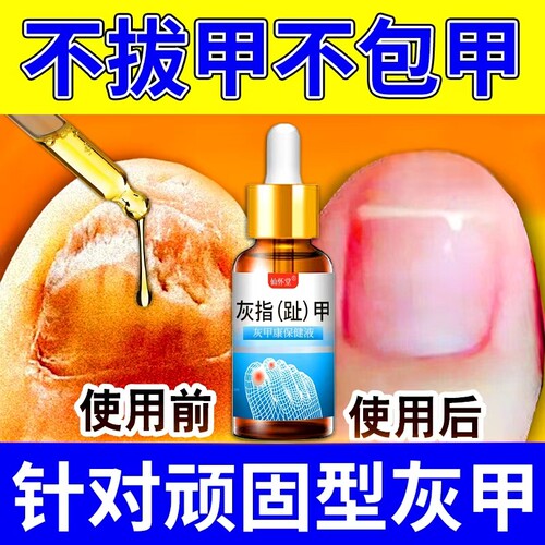 灰指甲专用脱甲膏凤仙花抑菌液