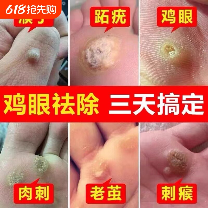 云南本草鸡眼贴鸡眼膏鸡贴眼正品去脚底鸡眼药膏去除液老茧草本