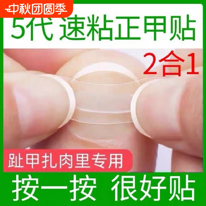 正甲贴片矫器内嵌扣德国沟卷