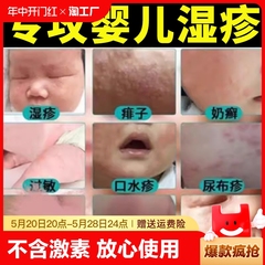 湿疹膏婴儿专用儿童宝宝湿疹口水疹无激素干性保湿面霜身体乳抑菌