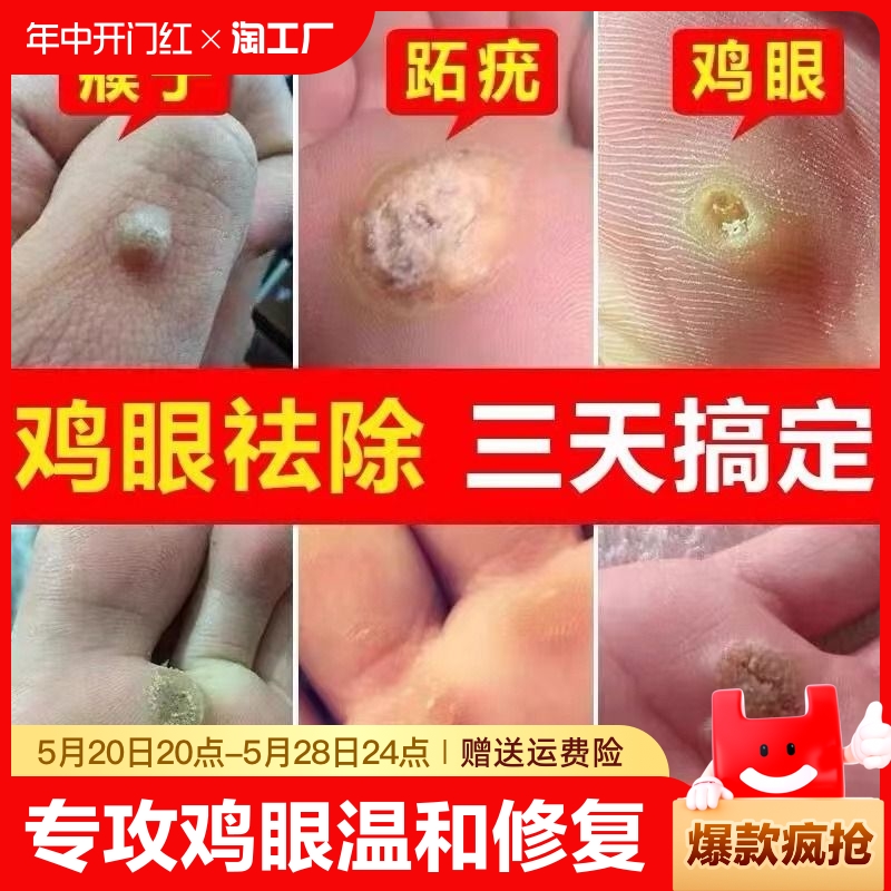 云南本草鸡眼贴鸡眼膏瘊子足部去脚底脚趾部跖疣灵老茧根肉刺