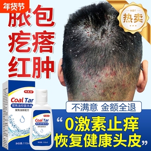 煤焦油洗剂官方旗舰店正品医用水屑去脂溢性皮炎去屑止痒健康