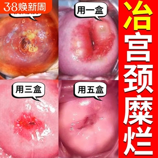 北京同仁堂宫颈糜烂重度专用中药消糜栓妇科凝胶治疗阴道炎白带多