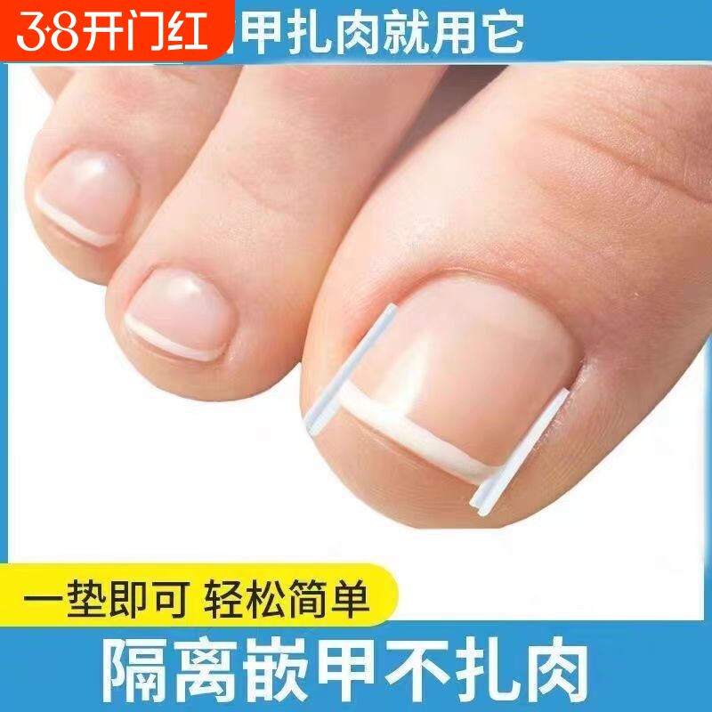 甲沟垫嵌甲指甲矫正器填充垫片正甲贴脚趾甲长肉里专用修甲刀棉花