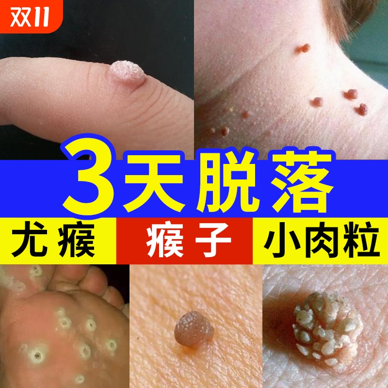 去除尤疣瘊猴子祛除扁平神器脖子上长小肉粒疙瘩一抹无忧灵药膏
