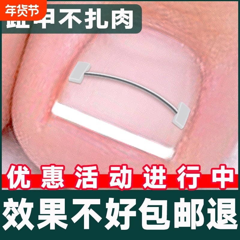 正甲丝镍钛合金记忆回弹钢丝正甲扣嵌甲矫正器正甲贴拉拉炎正甲垫,家庭/个人清洁工具,美甲/修甲套装,淘宝优惠券,粉丝福利购,淘宝优惠卷