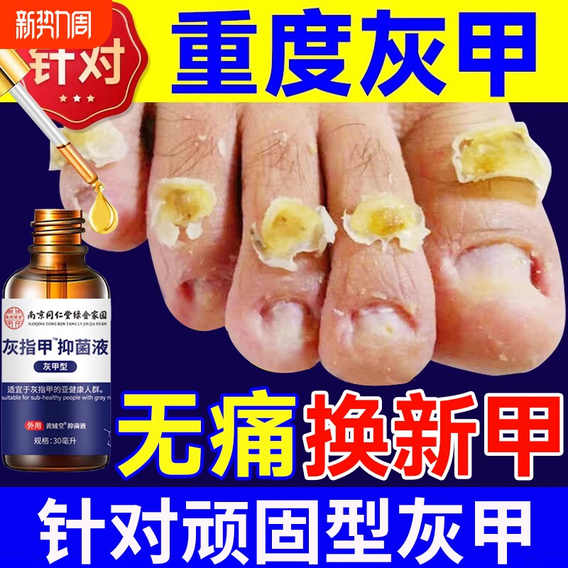 灰指甲脱甲膏软甲膏药贴去除增厚专用旗艦店正品抑菌搽剂
