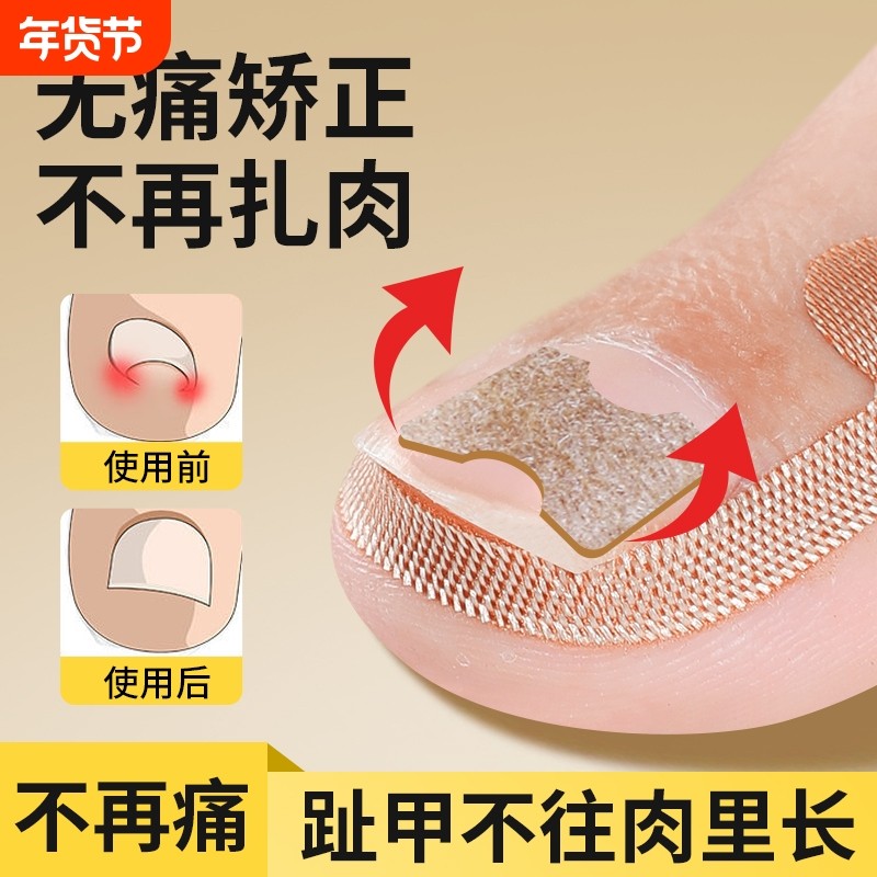 甲沟嵌甲矫正器甲沟脚指甲修正器炎内嵌脚趾甲勾盖长肉里纠正神器,家庭/个人清洁工具,美甲/修甲套装,淘宝优惠券,粉丝福利购,淘宝优惠卷