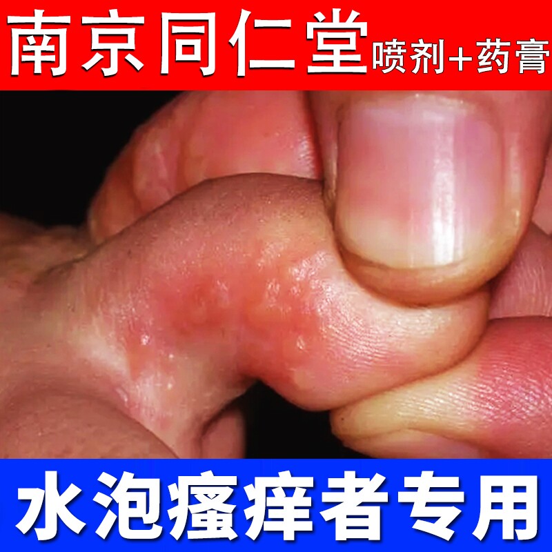水泡型脚气专用喷剂药膏同仁堂喷雾脚气有水泡药水除臭治疗真菌祛