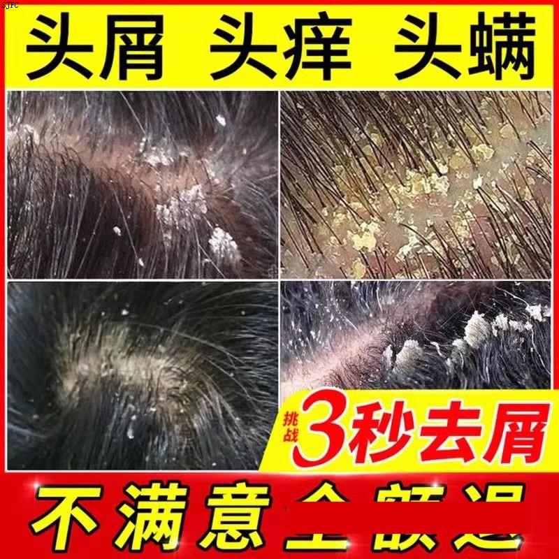 洗发水去屑止痒控油正品去头屑头皮屑专用去油排行榜第一名