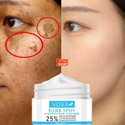 3pcs Effective Whitening Freckle Cream Remove Melasma Acne