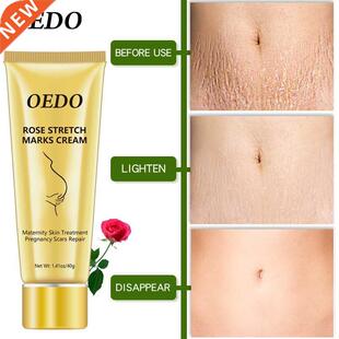 Rose Removes Stretch Mark Cream To Remove Postpartum Obesity