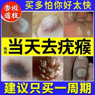 扁平疣去除膏非神器丝状疣去疣药膏瘊子小肉粒软膏寻常乳膏疣清宁