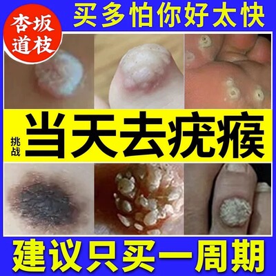扁平疣丝状疣去疣药膏