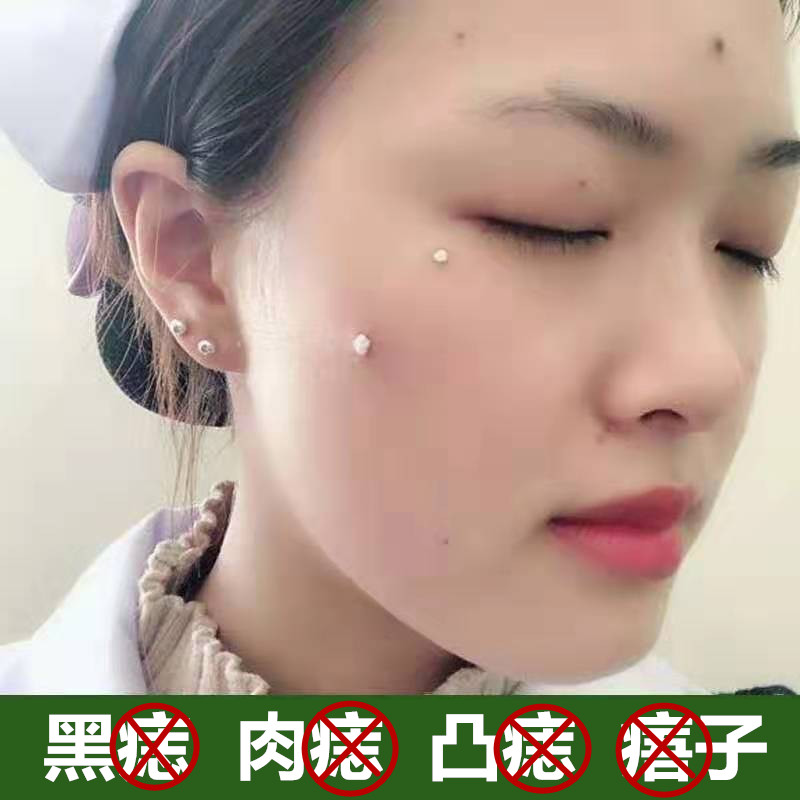 黑痣凸痣斑点痦子黑点套装