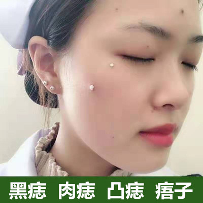 取脸黑点神器正品美容院点痦子的药水去脸部小黑点水液套装