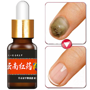 买2发3灰甲液抑菌液灰指甲肉分离脚指甲发黄变空甲床修复液生长液