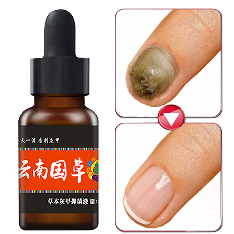 灰甲抑菌液灰指甲床修复液生长液