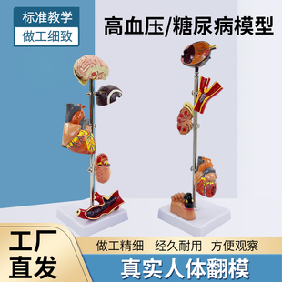 高/血压模型 5部分 血压 病理变 脑 眼 心脏 肾脏 血管内脏模型