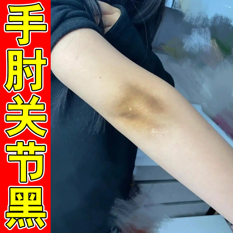 除手肘膝盖关节黑棘皮去胳膊肘黑皮肤消毒护理（消）