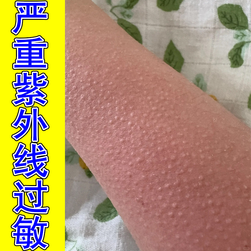 严重紫外线过敏手臂长小疙瘩干痒粗糙身上皮肤胳膊痒专用修复乳膏